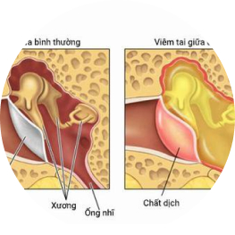 Chữa viêm tai giữa ứ dịch
