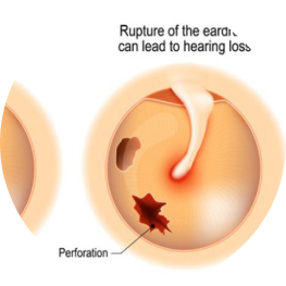 Viêm tai xương chũm mạn tính có cholesteatoma