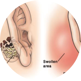 Viêm tai xương chũm cấp