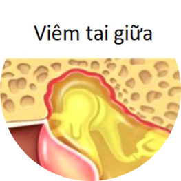 Viêm tai giữa cấp