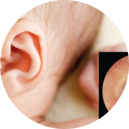 Viêm tai giữa ứ dịch