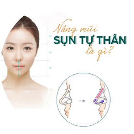 Nâng mũi bằng sụn tự thân