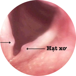 Hạt xơ dây thanh