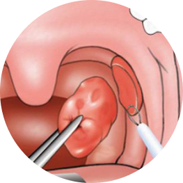 Áp xe thành sau họng