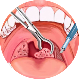 Chỉ định cắt amidan