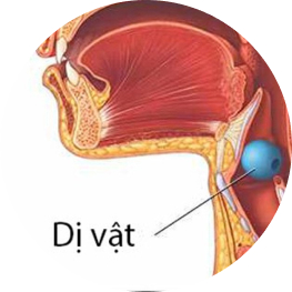 Dị vật phế quản