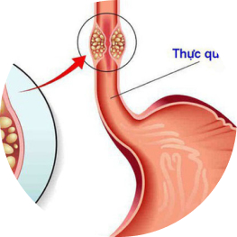 Bệnh trào ngược dạ dày thực quản