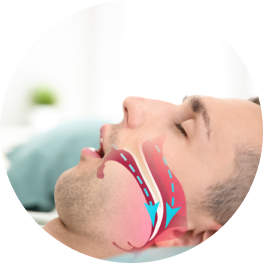 Ngủ ngáy và hội chứng ngừng thở khi ngủ