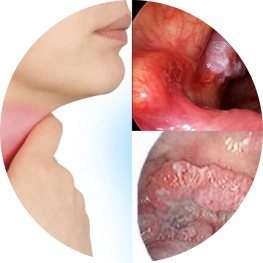 Ung thư thanh quản