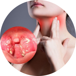 Viêm amidan