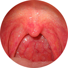 Viêm họng mạn tính