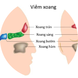 Viêm xoang sau, một bệnh hay bị bỏ sót